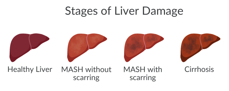 Stages of Liver Damage